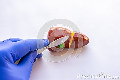 Concept of photo of cholecystectomy surgery operation or gallbladder or bile bladder of patient. Doctor holds in his hand, dressed Stock Photo