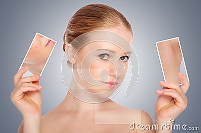 Concept skincare . Skin of beauty young woman with acne Stock Photo