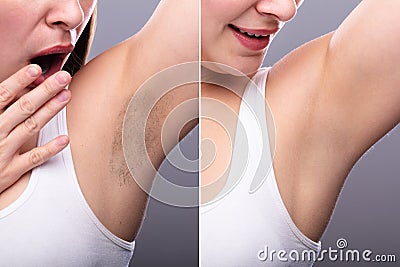 Before And After Concept Of Underarm Hair Removal Stock Photo