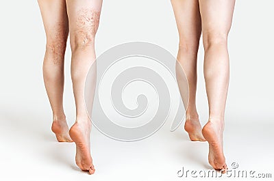 The concept of varicose veins and cosmetic treatment. A caucasian woman massages her legs with and without vascular stars.Rear Stock Photo