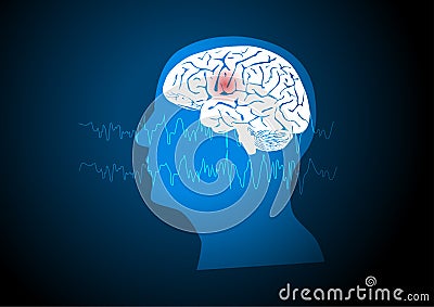 Concepts of human focal seizure or epilepsy Stock Photo