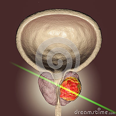 Conceptual image for prostate cancer treatment Cartoon Illustration