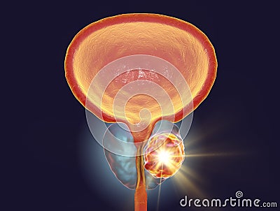 Conceptual image for prostate cancer treatment Cartoon Illustration