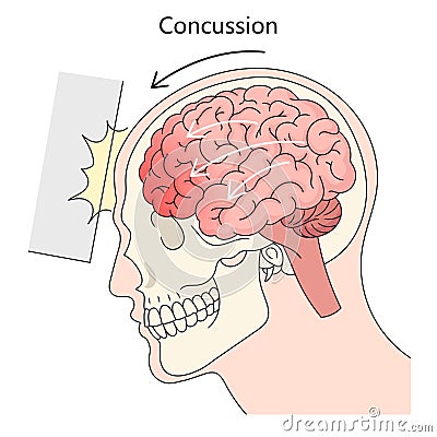 Concussion structure diagram medical science Vector Illustration