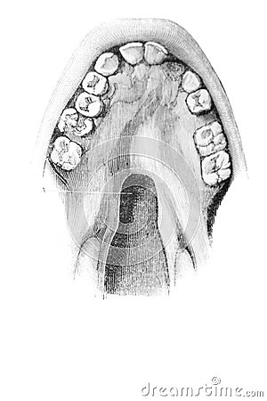 Congenital fissure of the soft palate in the old book D`Anatomie Chirurgicale, by B. Anger, 1869, Paris Stock Photo