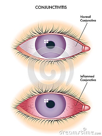 Conjunctivitis Vector Illustration