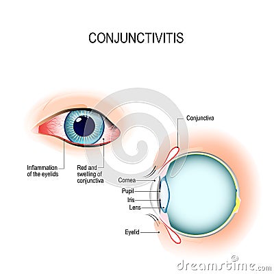 Conjunctivitis. External View and Vertical section of the human Vector Illustration