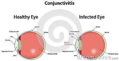 Conjunctivitis Vector Illustration