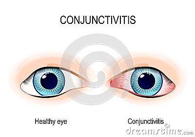 Conjunctivitis Vector Illustration