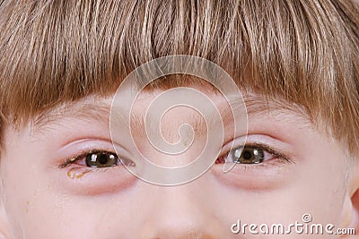 Conjunctivitis - ill allergic eyes Stock Photo