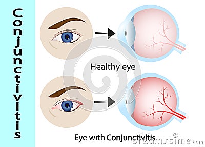 Conjunctivitis. pink eye with inflammation. External View and Vertical section of the human eyes and eyelids. Vector Illustration