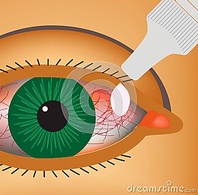 Conjunctivitis. Redness and inflammation of the eye. Vessels. Eye drops. Infographics. Vector illustration. Vector Illustration