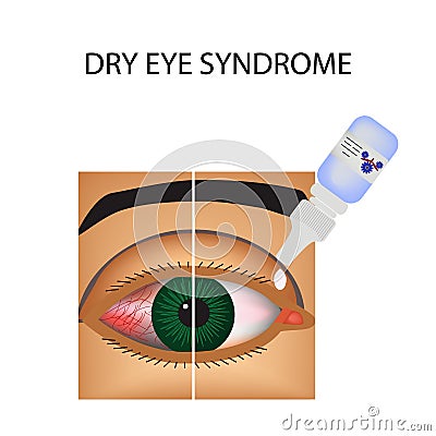 Conjunctivitis. Redness and inflammation of the eye. Vessels. Eye drops. Treatment. Infographics. Vector illustration Vector Illustration