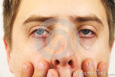 Conjunctivitis, tired eyes, red eyes, eye disease Stock Photo