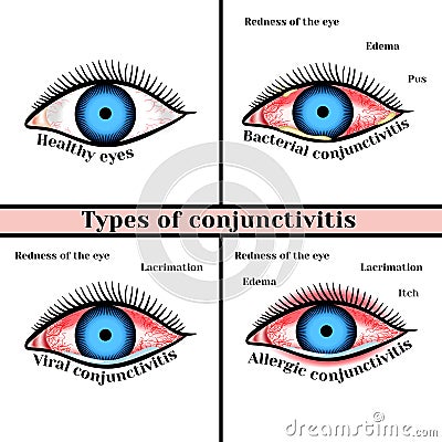 Conjunctivitis types. Inflammatory diseases of eyes Vector Illustration