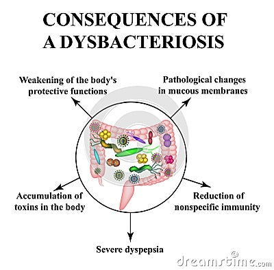 Consequences of intestinal dysbiosis. Dysbacteriosis of the colon Infographics Vector Illustration