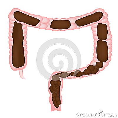 Constipation. Feces in colon. Infographics. Vector illustration on isolated background. Vector Illustration