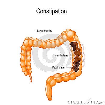 Constipation. human large intestine with fecal matter Vector Illustration