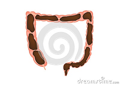 Constipation in intestine / colon Stock Photo