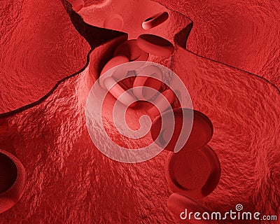 Constricted blood vessels coronary heart disease 3d rendering Stock Photo