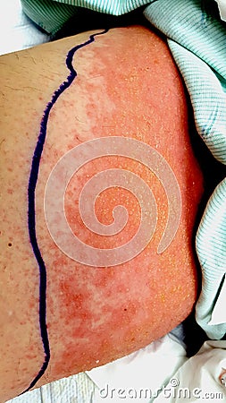 Contact dermatitis with secondary streptococcal cellulitis and lymphangitis Stock Photo