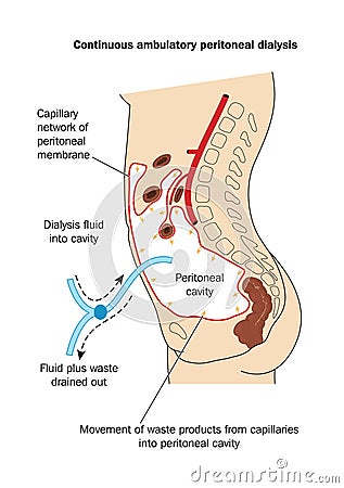 Continuous ambulatory peritoneal dialysis Vector Illustration