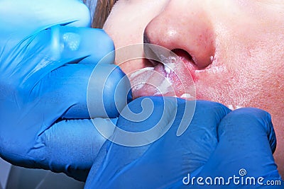 Contour plastic: Dermatologist performs lips massage after the c Stock Photo