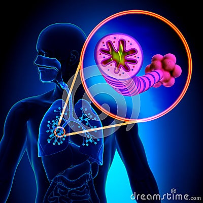 COPD - Chronic obstructive pulmonary disease Stock Photo