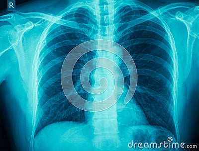 Copd Stock Photo