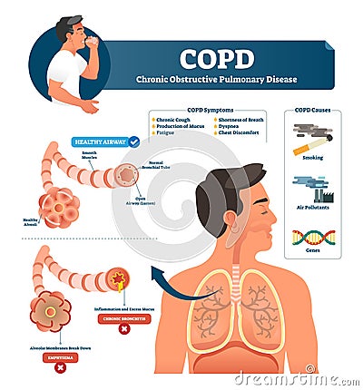 COPD vector illustration. Labeled chronic obstructive pulmonary explanation Vector Illustration