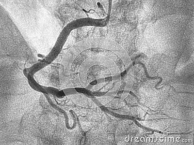 Coronary angiogram Stock Photo