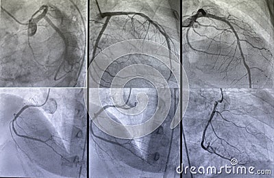 Coronary angiogram. medical x-ray Stock Photo