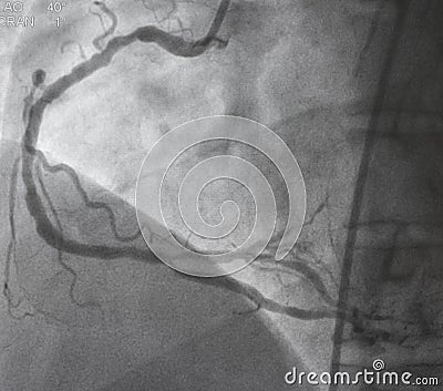 Coronary angiography.right coronary angiography. Stock Photo