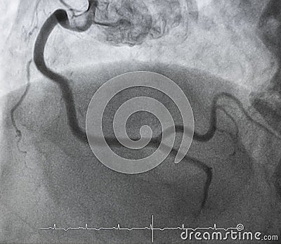 Coronary angiography.right coronary angiography. Stock Photo