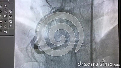 Coronary Angiography. X-ray Image. Vedio Angiogram Stock Footage - Video of  ischemia, health: 206841168