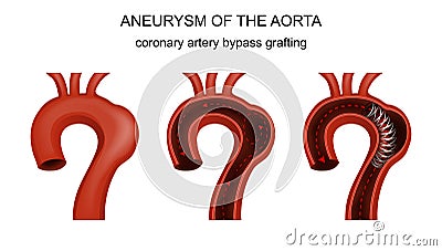 Coronary artery bypass grafting Vector Illustration