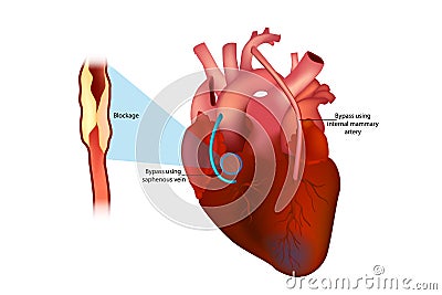 Coronary artery bypass surgery Vector Illustration