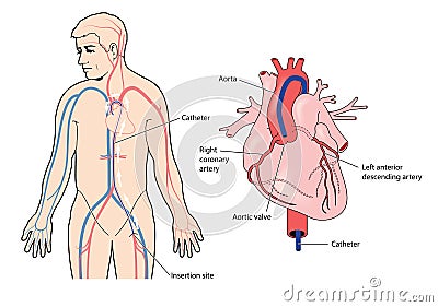 Coronary artery catheter Vector Illustration