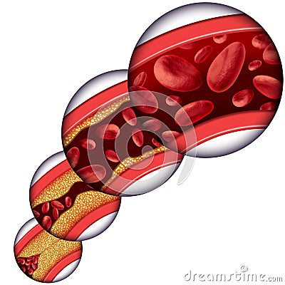 Coronary Artery Cholesterol Therapy Stock Photo