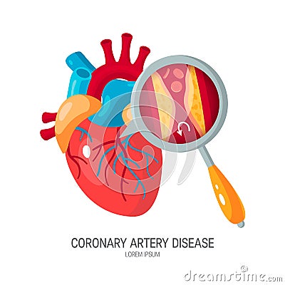 Coronary artery disease concept in flat style Vector Illustration