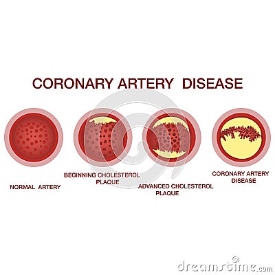 Coronary artery disease concept. Healthy and narrowed arteries with plaques Vector Illustration