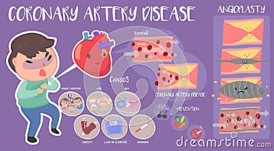 Coronary artery disease infographic Vector Illustration