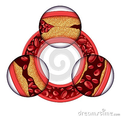 Coronary Artery Disease Stock Photo