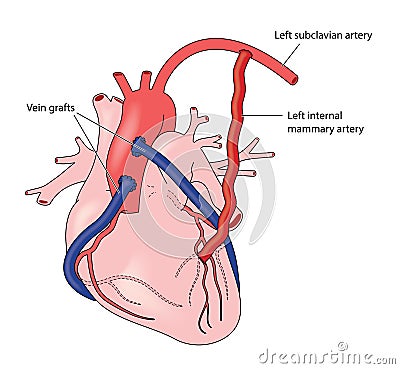 Coronary artery grafts Vector Illustration