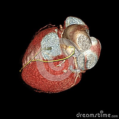 Coronary artery Stock Photo