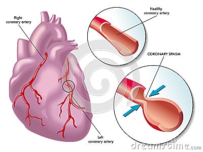 Coronary artery spasm Vector Illustration
