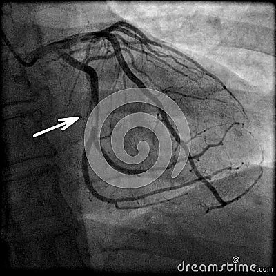 Coronary artery stenosis on angiography Stock Photo