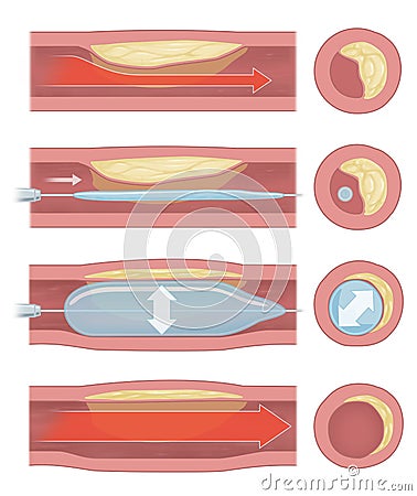 ballon implantation Stock Photo