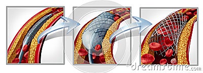 Coronary Stent Diagram Cartoon Illustration