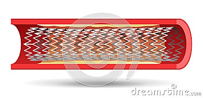 Coronary stent implant in blood vessel Vector Illustration